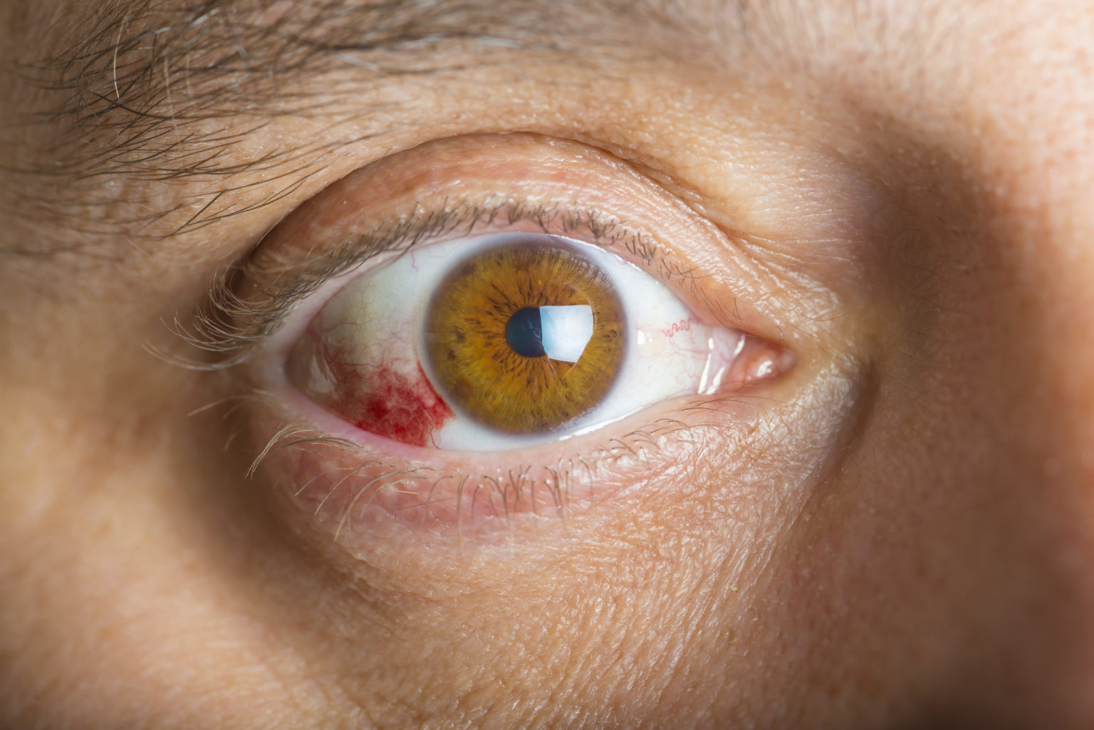 What is Conjunctivitis? - KE - Eye Centers of Texas