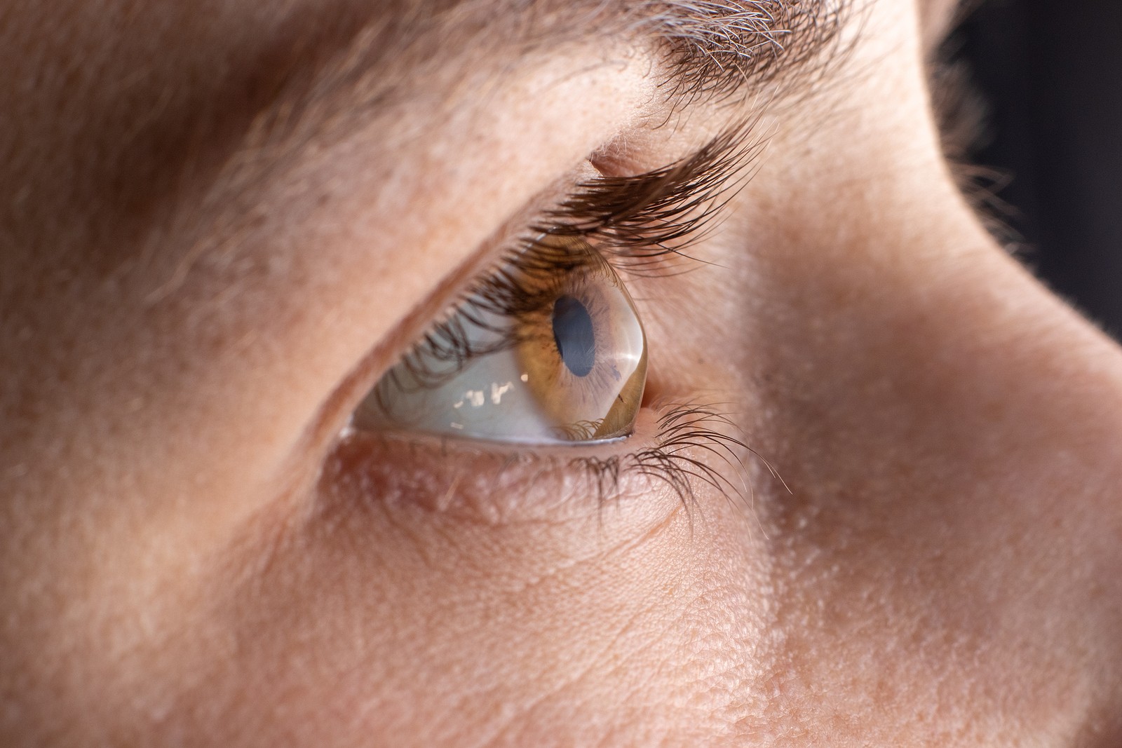 keratoconus eye condition
