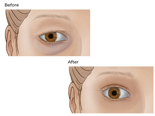 Before and After Animations of Blepharoplasty Surgery