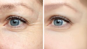 before and after botox injections around eyes