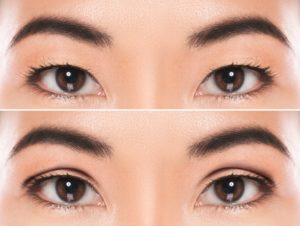 before and after double eyelid surgery