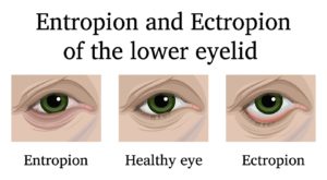 entropion and ectropion of lower eyelid