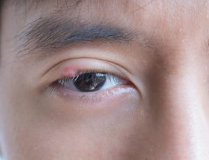 man with growth on eyelid