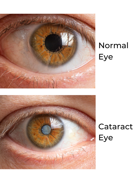 Kleiman Evangelista Normal Eye versus Cataract Eye desktop