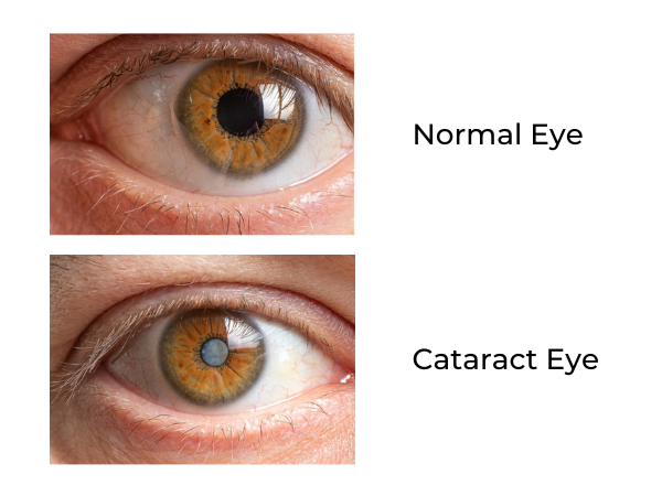 Kleiman Evangelista Normal Eye versus Cataract Eye mobile