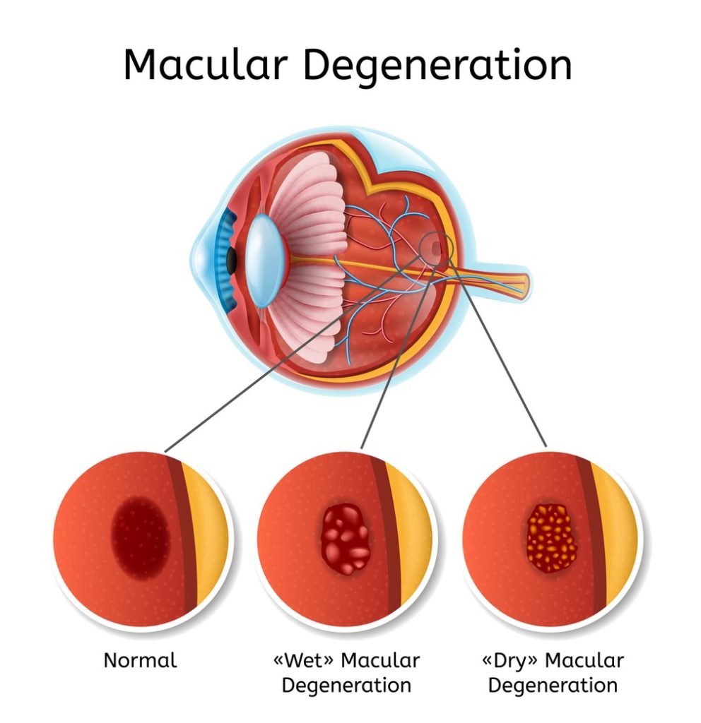 macular degeneration infographic Kleiman Evangelista Eye Centers