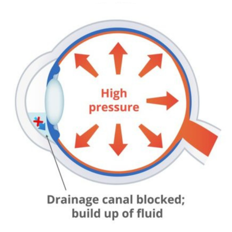 Understanding Glaucoma